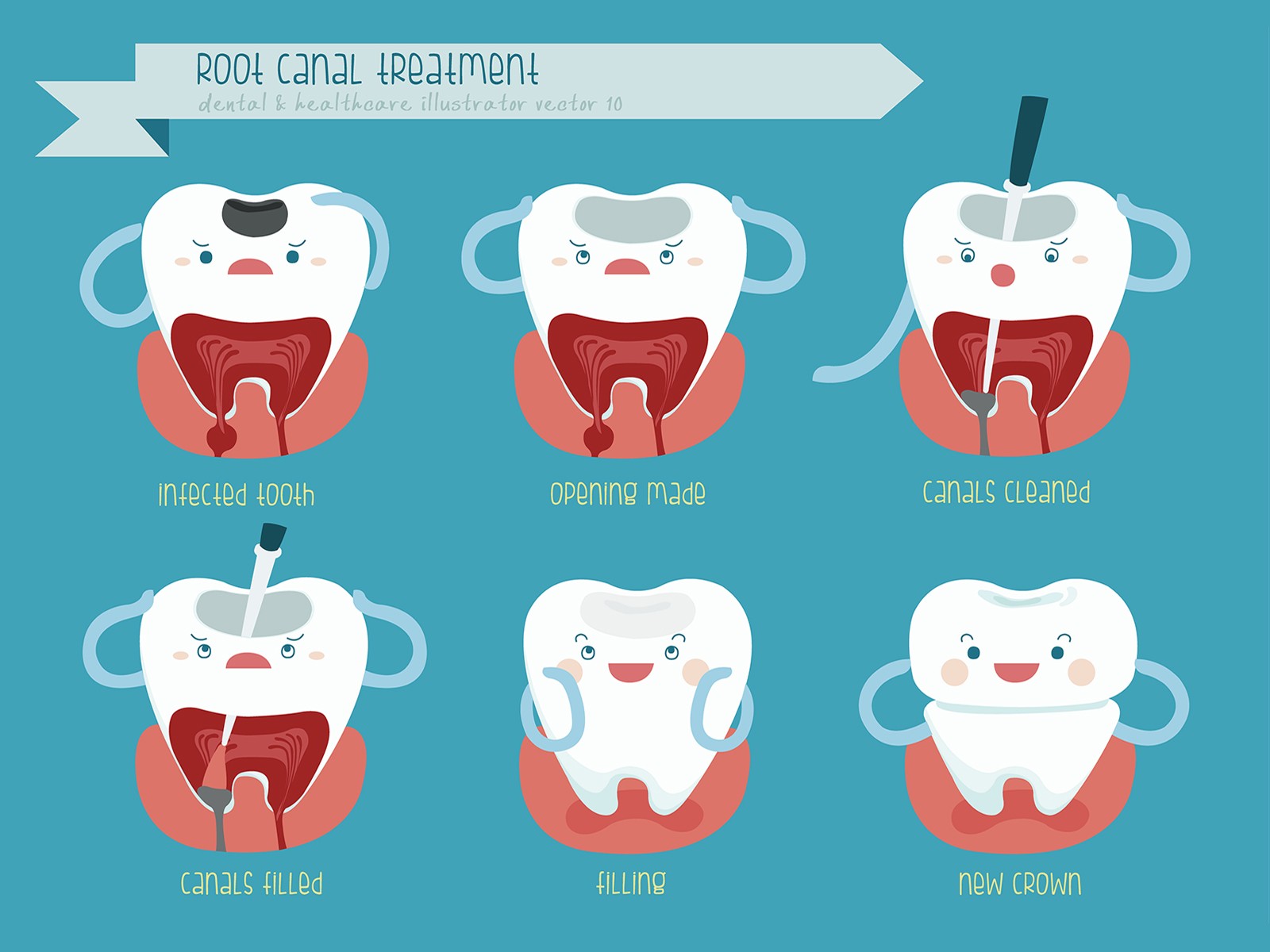 What is a Root Canal, and Why Do I Need One?