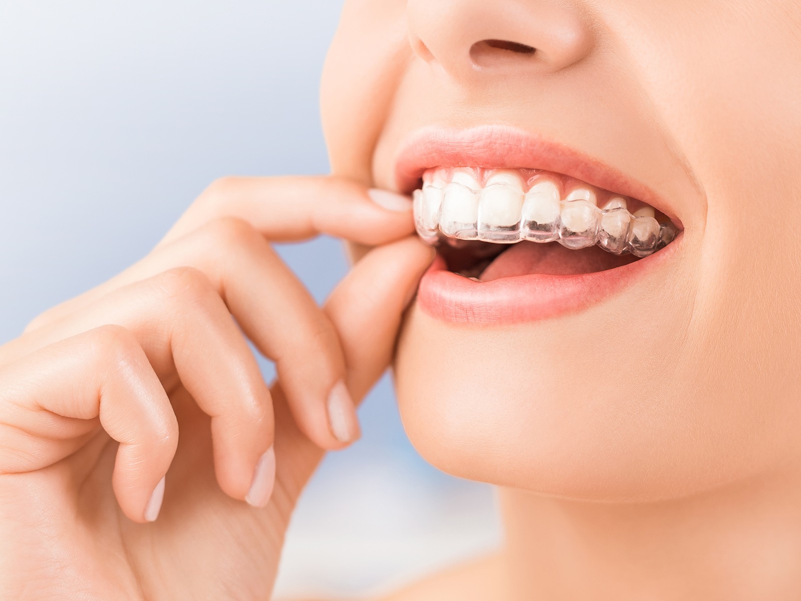 How long is the Invisalign process?