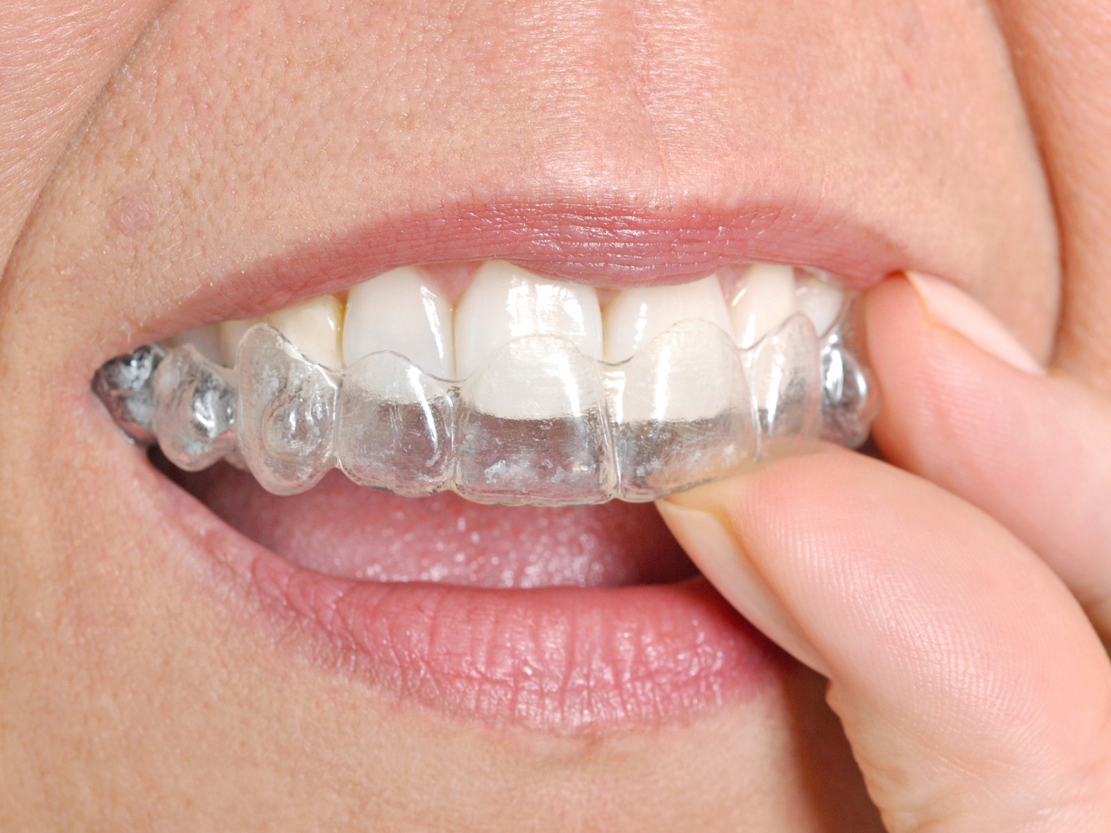 Why do Invisalign have bumps?
