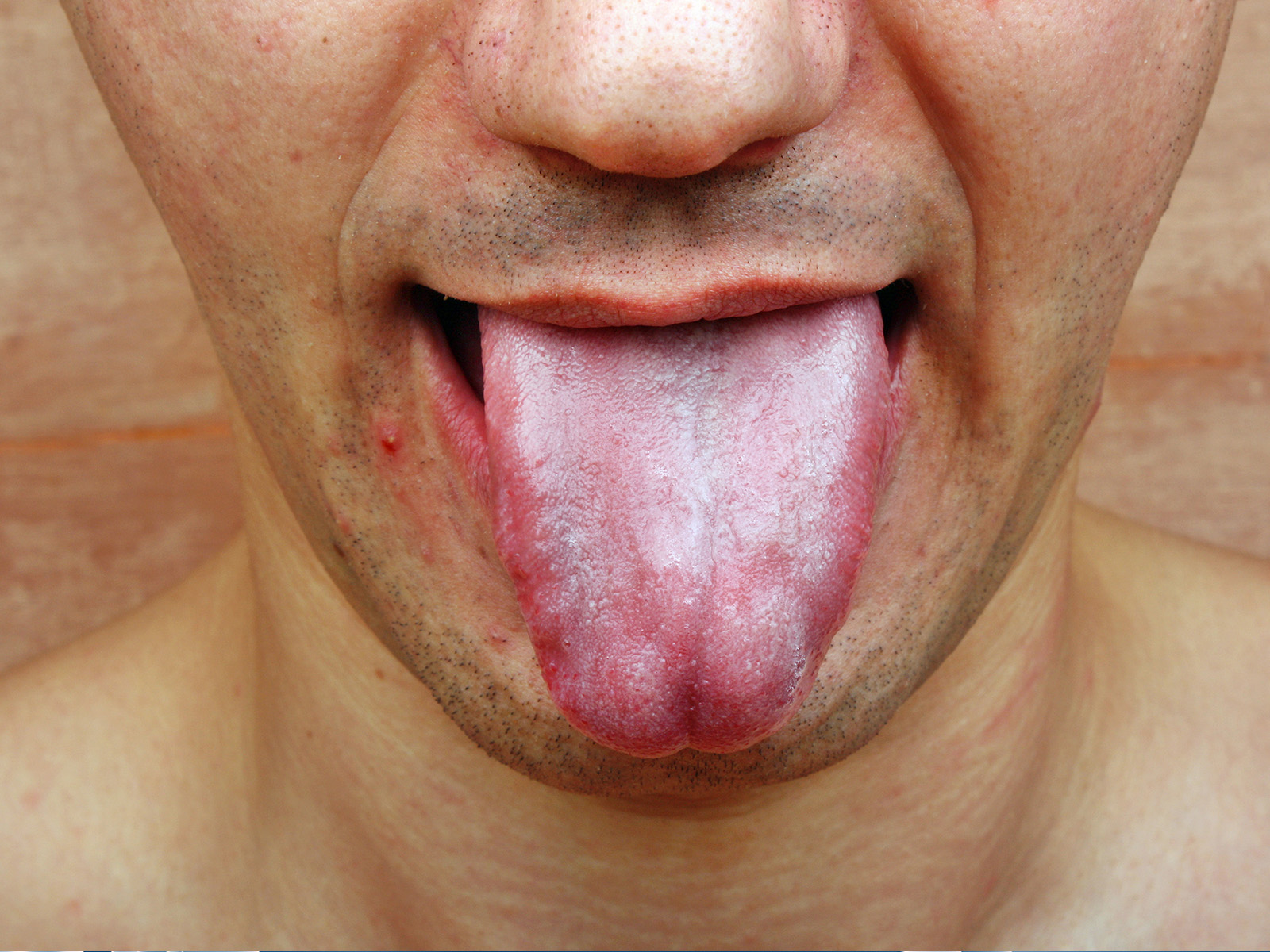 Burning Tongue: 5 Common Causes & How To Treat