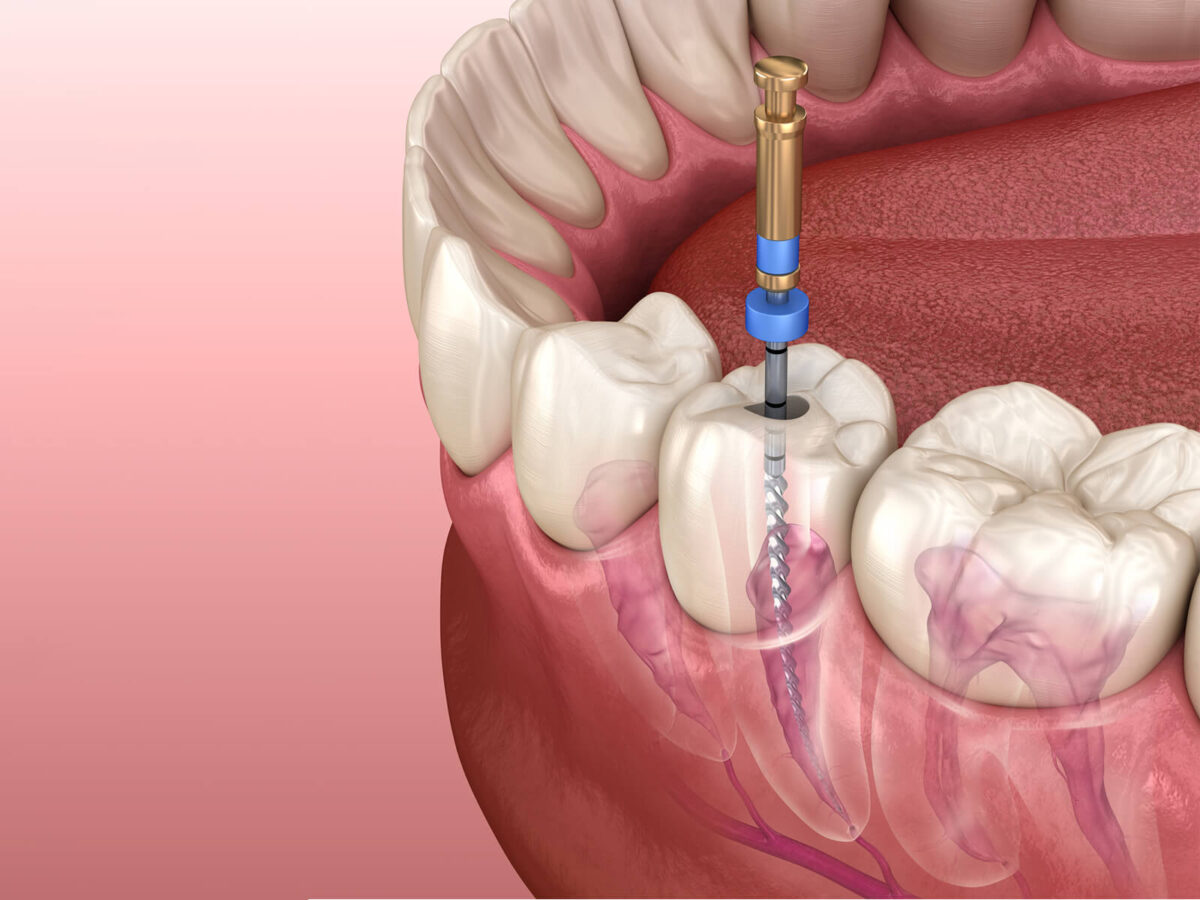 Emergency Root Canal Treatment