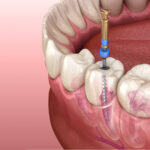 Emergency Root Canal Treatment