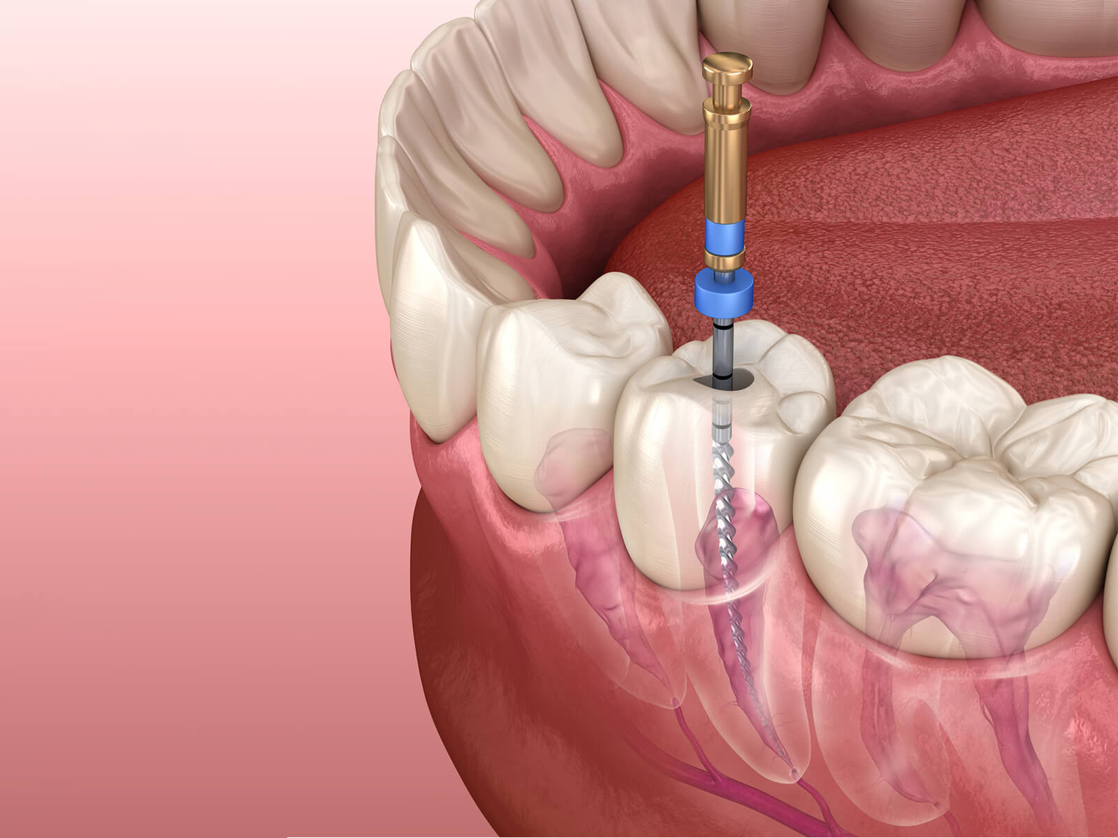 Emergency Root Canal Treatment: A Comprehensive Guide