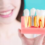 6 Essential Tips For Faster Dental Implant Recovery