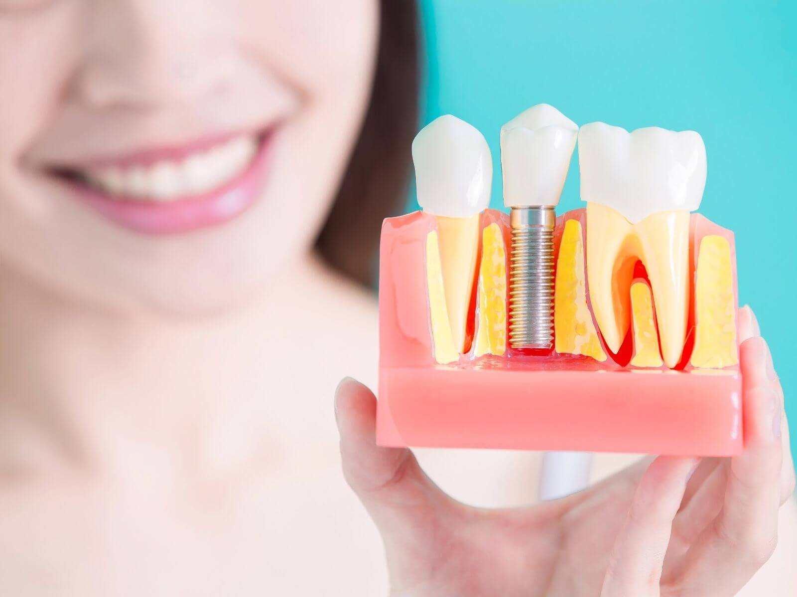 6 Essential Tips For Faster Dental Implant Recovery