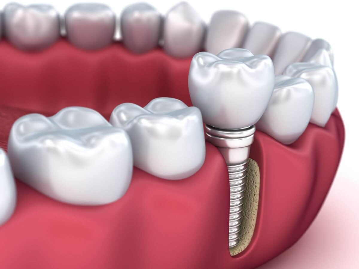 The Role Implant Dentists Play In Smile Makeovers