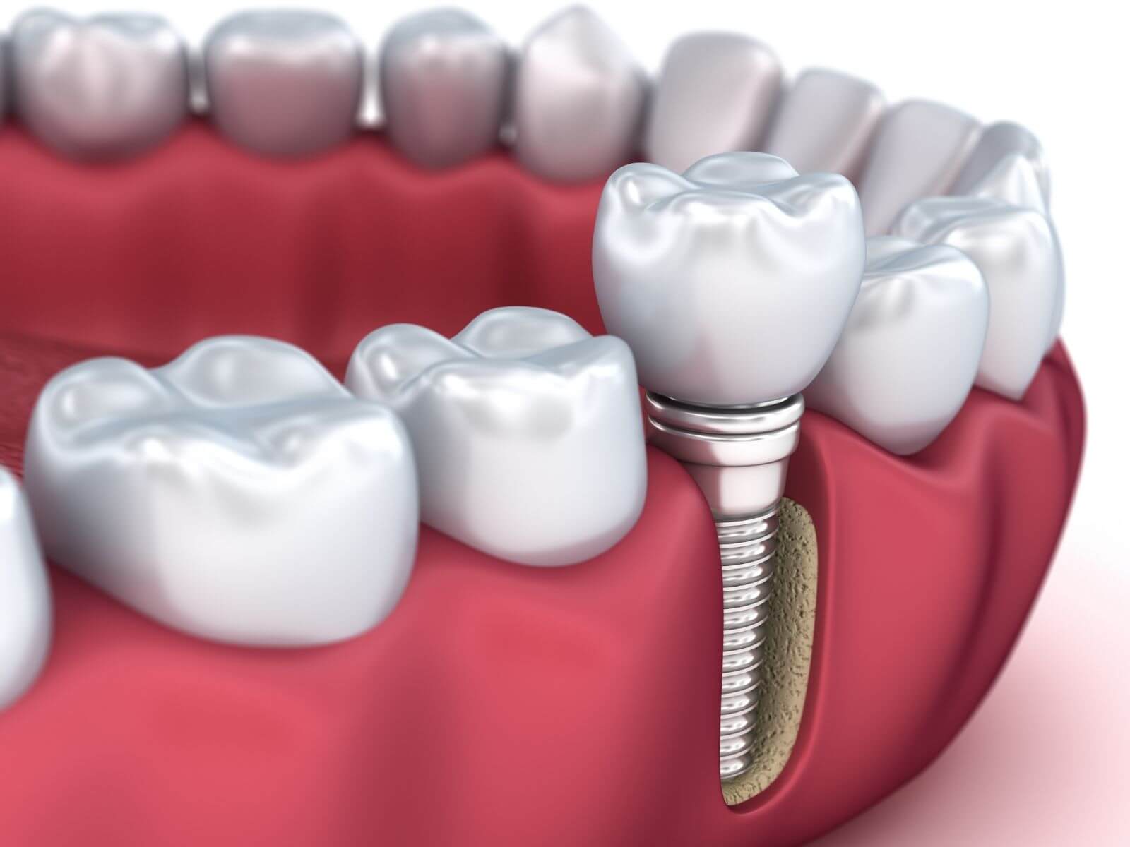 The Role Implant Dentists Play In Smile Makeovers