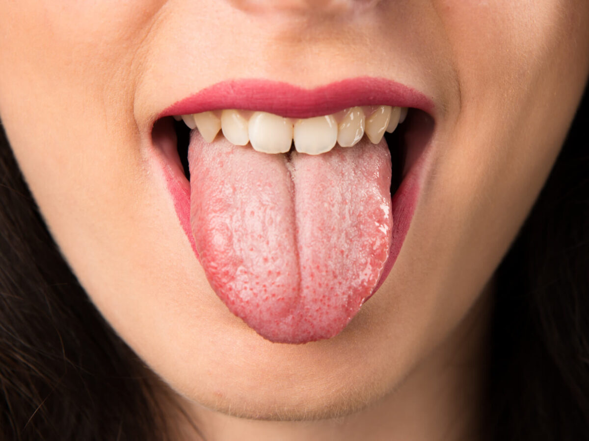 Top 10 Natural Remedies for Dry Mouth Relief