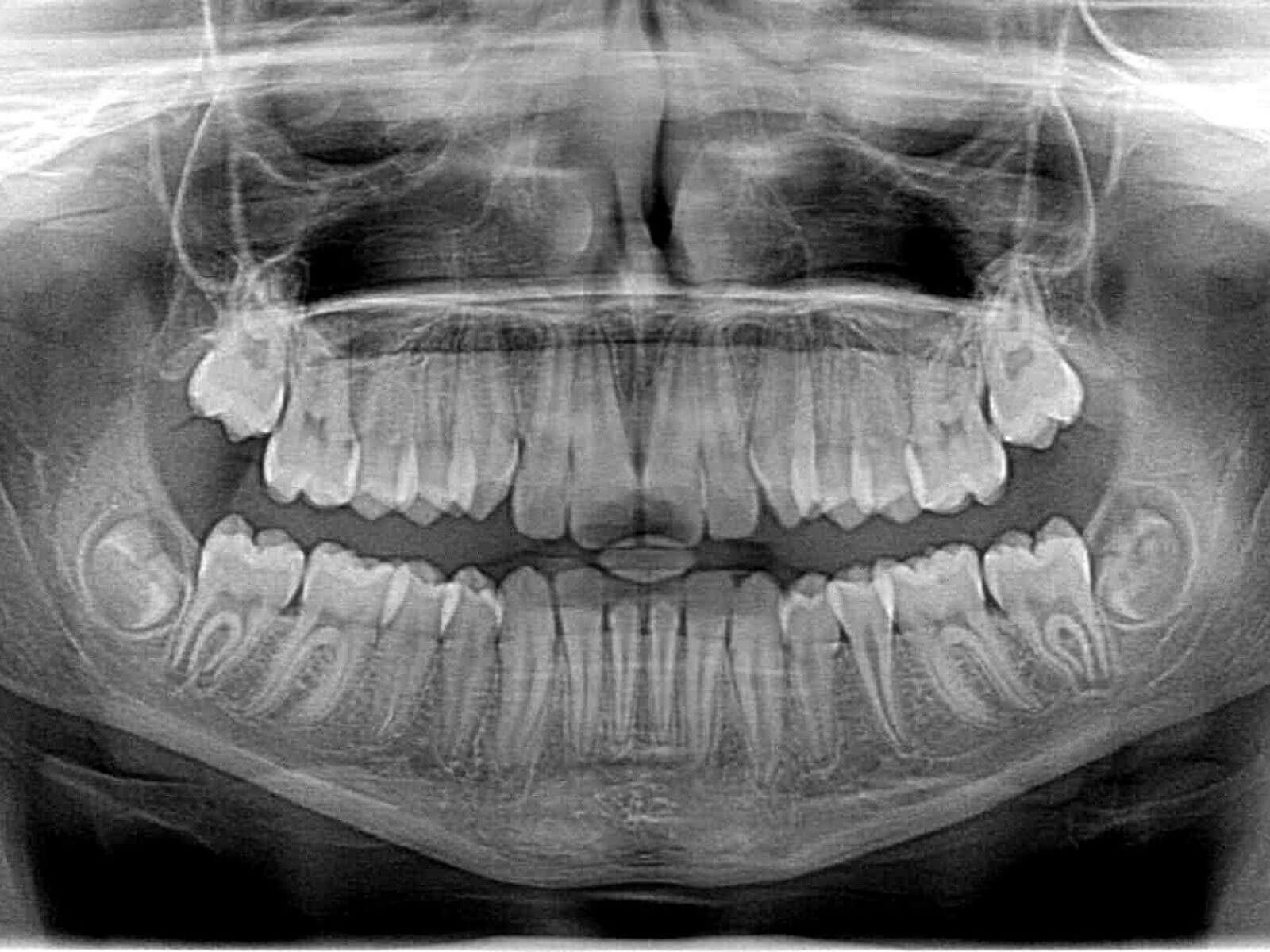 How Dental X-Rays Help Detect Hidden Oral Problems