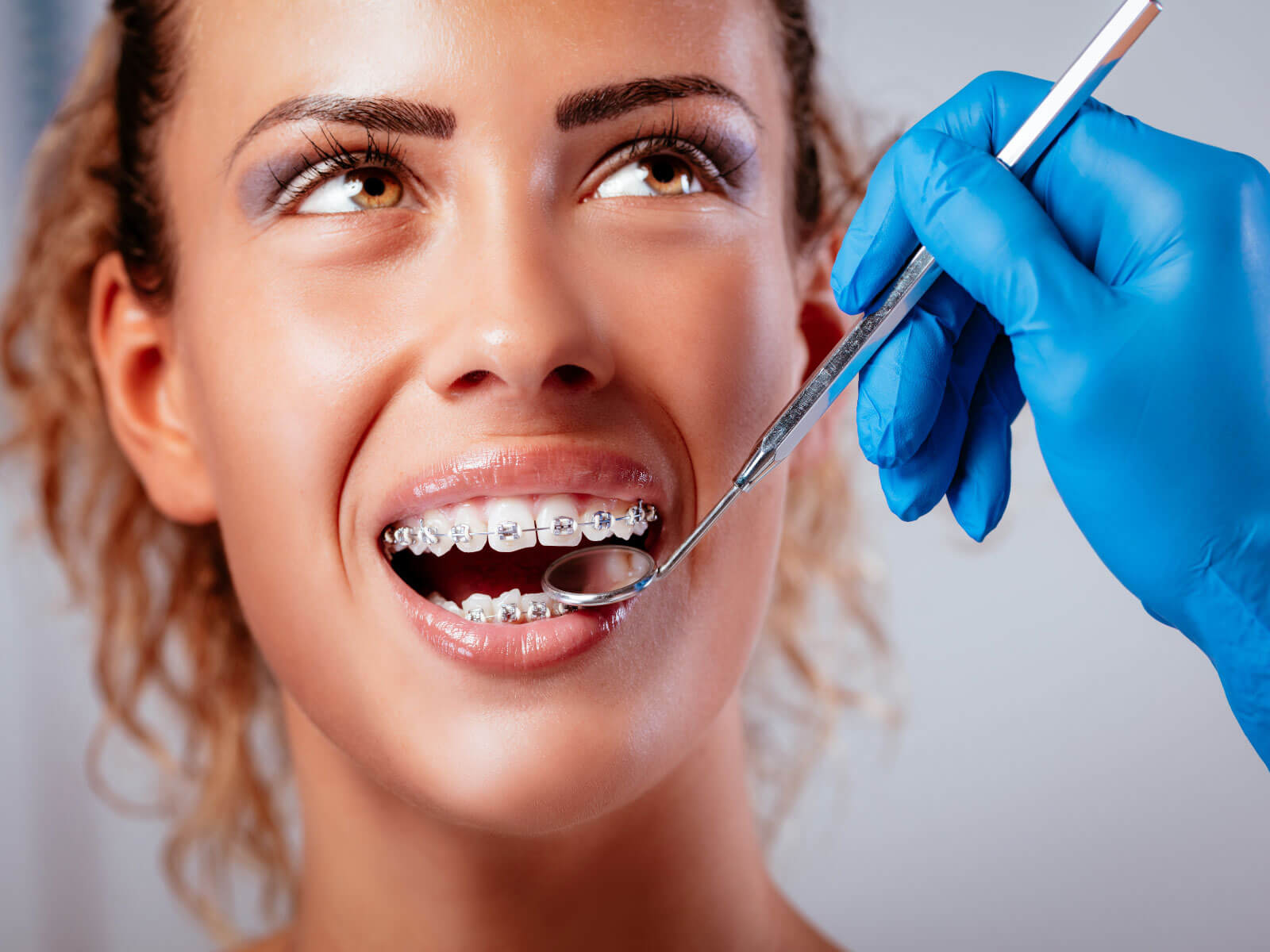 How Long Do You Have to Wear Braces?